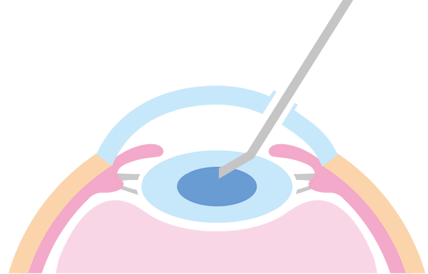 細いメスで、角膜（黒目）と強膜（白目）の境目に小さな創口を作ります。